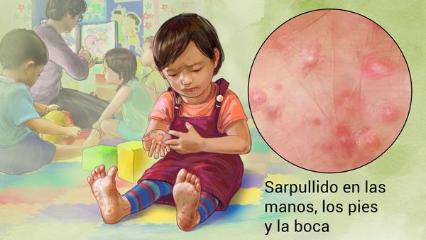 La enfermedad manos boca y pies se esta propagando en santo domingo