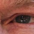 Pacientes graves de coronavirus presentan anomalías en los ojos.