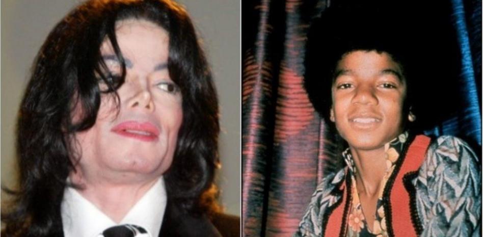 El vitíligo, la enfermedad de piel que padecía Michael Jackson