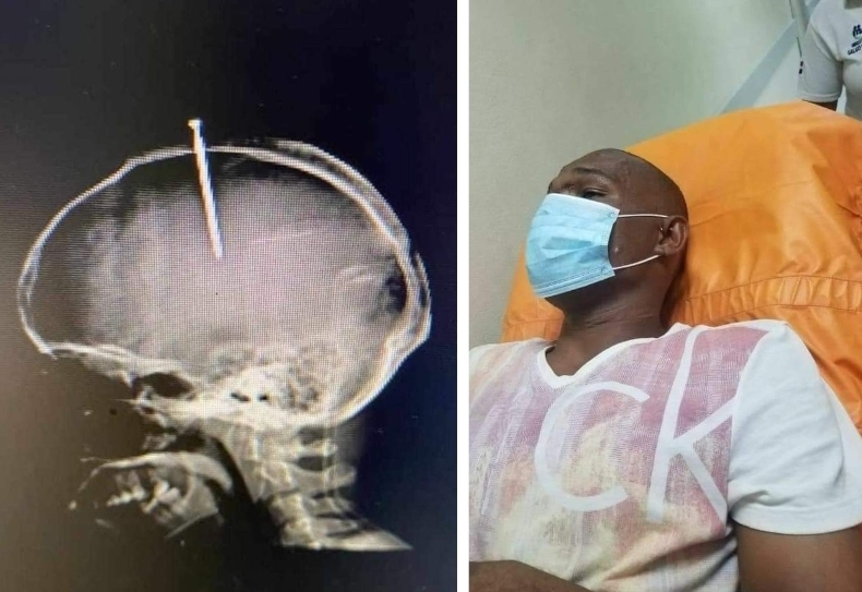 Por sentirse el “cerebro flojo”, hombre se clavó un clavo en la cabeza en Puerto Plata.