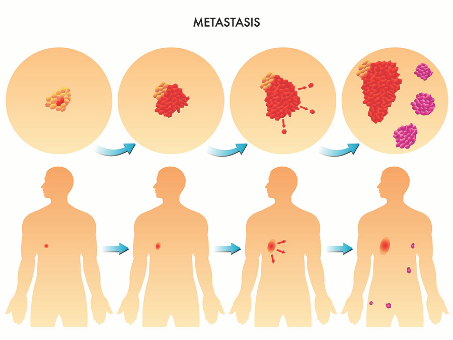 Metástasis 