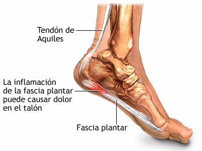 Fascitis plantar: síntomas comunes, factores de riesgo y posible tratamiento